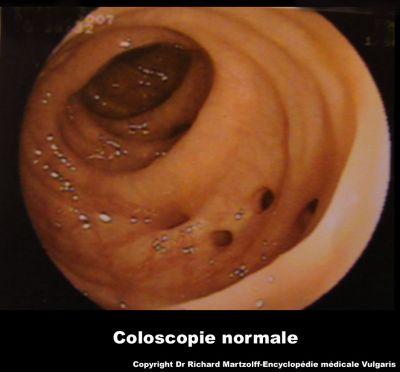 Les premiers signes dcancer du colon
