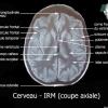 Cerveau - I.R.M  (coupe axiale)