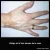Vitiligo de la main