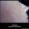 Masque de grossesse (chloasma)