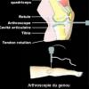 Arthroscopie du genou (schéma)