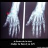 Main (radiographie d&#039;une arthrose de la)