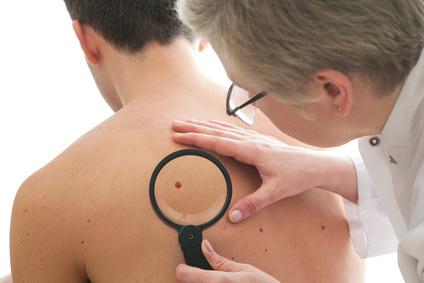 Cancer de la peau : journée de dépistage gratuit partout en France