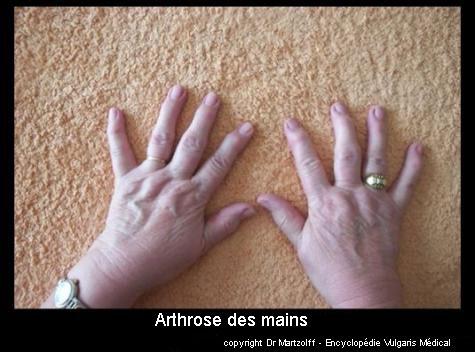 Arthrose des mains