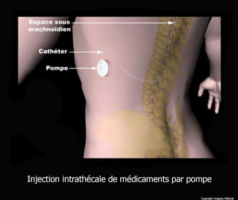 Injection intrathécale par pompe
