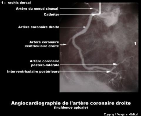 Angiocardiographie de l&#039;artère coronaire droite