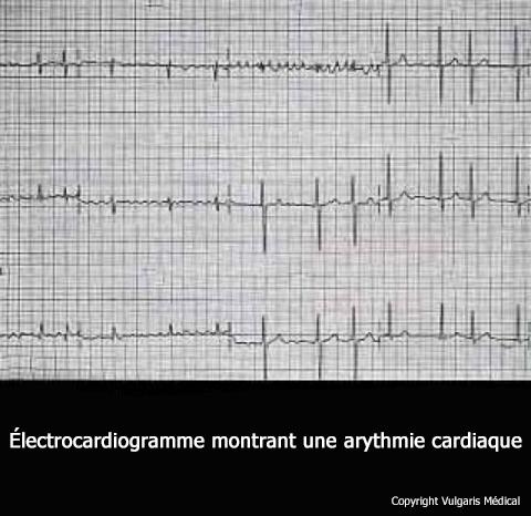 Arythmie cardiaque (électrocardiogramme)