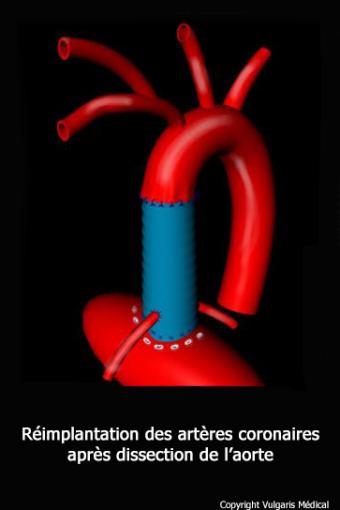 Dissection de l&#039;aorte (traitement chirurgical)