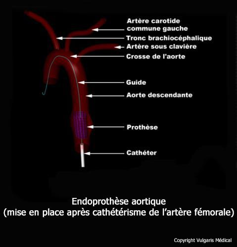 Endoprothèse aortique