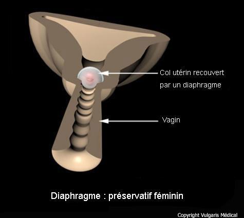 Diaphragme : préservatif féminin (schéma)