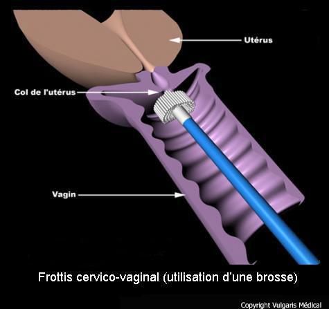 Frottis cervico-vaginal : technique utilisant la brosse (schéma)
