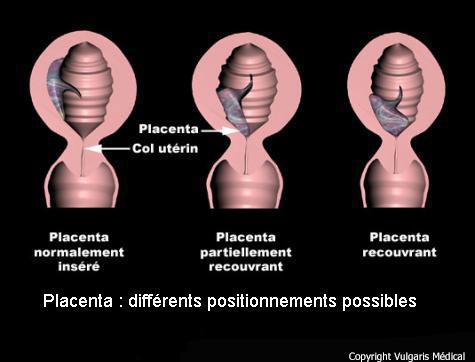 Placenta : différents positionnements (schéma)