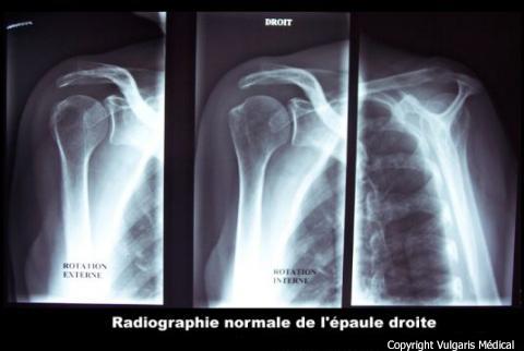 Épaule (radiographie normale)