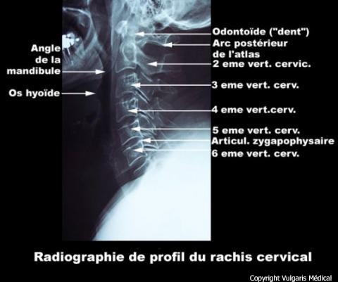 Rachis cervical (radiographie de profil avec légendes)