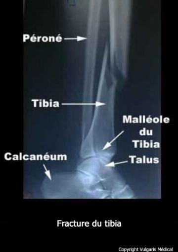 Tibia (fracture du) radiographie