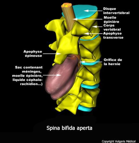 Spina bifida aperta