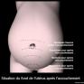 Position du fond de l&#039;utérus après l&#039;accouchement (schéma)
