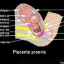 Placenta praevia (schéma)