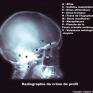 Crâne (radiographie de profil)