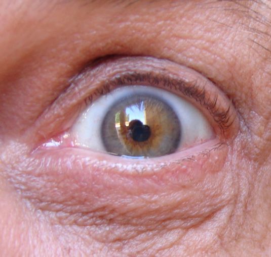 une-puce-electronique-dans-loeil-pour-surveiller-le-glaucome