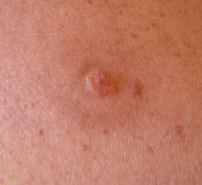 Cancer : les signes qui doivent vous alerter