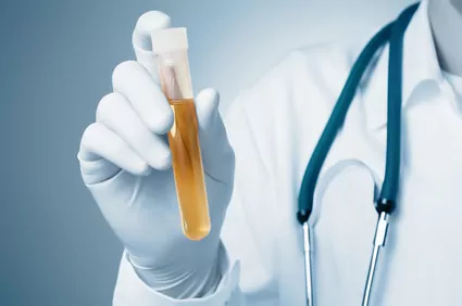 Cancer du col de l'utérus : une simple analyse d'urine pour le dépister !