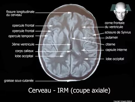 Cerveau - I.R.M  (coupe axiale)