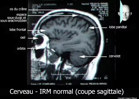 Cerveau  - IRM (coupe sagittale)
