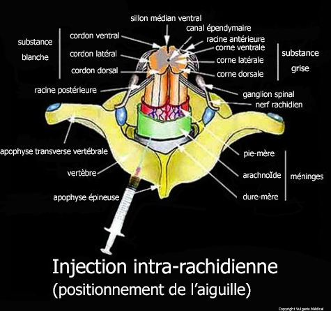 Injection intra-rachidienne