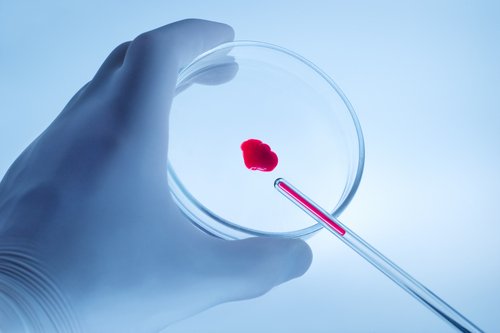 Anémie : causes, symptômes, traitements