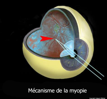 Myopie - mécanisme (schéma)