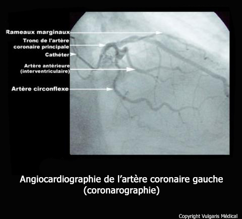 Coronarographie Anatomie Photo Et Illustration Coronarographie Anatomie Photo Et Illustration