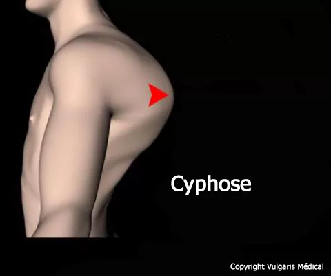 Cyphose