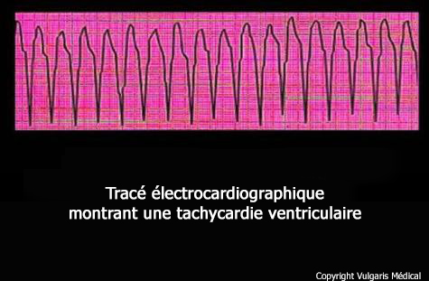Tachycardie (électrocardiogramme)