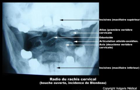 Bouche ouverte (radiographie, incidence de Blondeau)