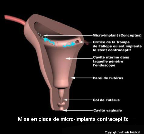 Contraception par implants à l'intérieur des trompes de Fallope (schéma)