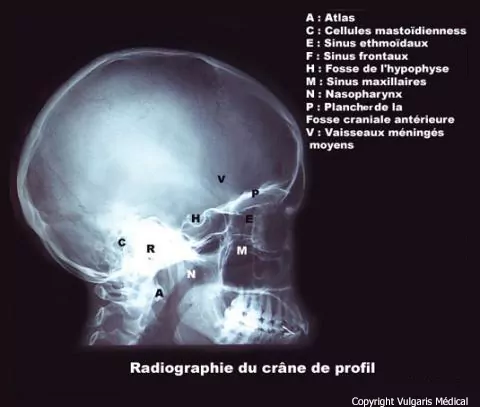Crâne (radiographie de profil)