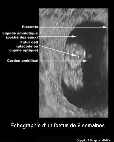 Échographie d'un foetus de six semaines
