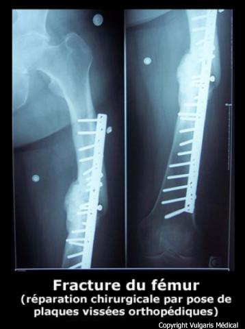 Fémur (radiographie d'une fracture avec ostéosynthèse)