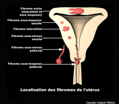Fibromes utérins (localisation)
