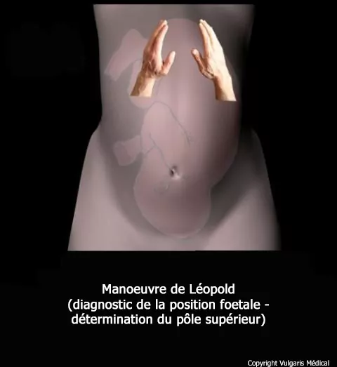 Manoeuvre de Léopold (palpation du pôle supérieur)