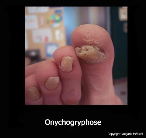 Onychogryphose