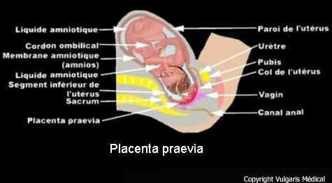 Placenta praevia (schéma)