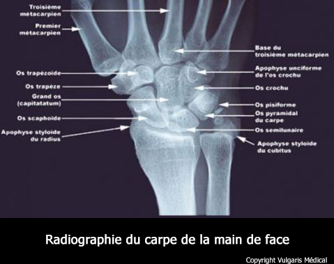 Radiographie du carpe
