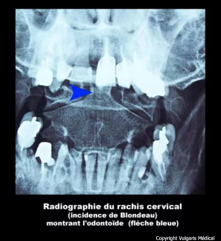 Radiographie du rachis cervical (incidence de Blondeau)