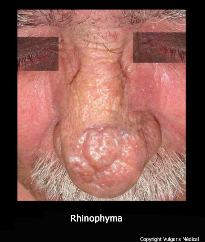 Rhinophyma