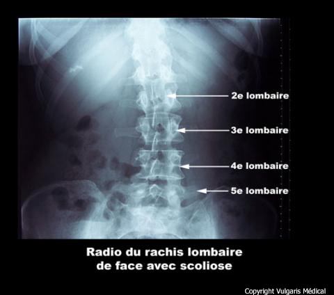 Scoliose lombaire (radiographie du bassin de face)