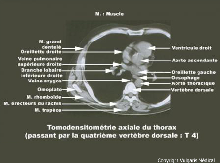 Tomodensitométrie du thorax passant par la quatrième vertèbre dorsale.