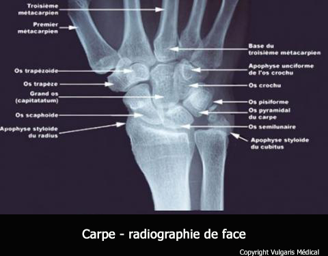 Carpe (radiographie de face)
