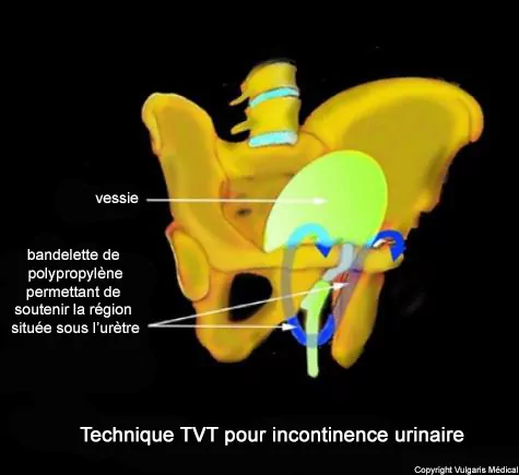 Incontinence urinaire - fronde de TVT